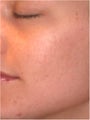 Fraxel - Acne Scarring