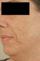 Laser Acne Scar Removal