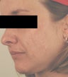 Laser Acne Scar Removal