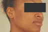 Laser Acne Scar Removal