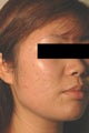 Laser Acne Scar Removal