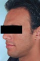 Laser Acne Scar Removal
