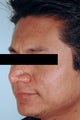 Brown Acne Scars in Santa Ana, CA. Remove Acne Scars with Lasers.
