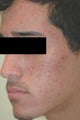 Laser Acne and Acne Scar Treatment