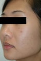 Laser Acne Scar Removal