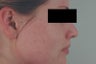 Laser Acne Scar Removal