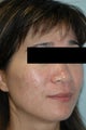 Laser Acne Scar Removal
