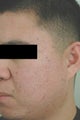 Laser Acne Scar Removal