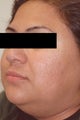 Acne scar treatment