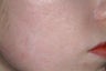 Acne scar treatment