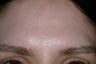 Acne scars