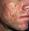 Acne Scarring