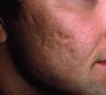 Acne Scarring