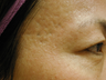 Acne Scars