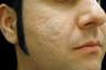 CO2 Affirm - Acne Scars