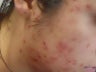 Severe Acne - Photodynamic Treatment