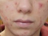 Severe Acne - Photodynamic Treatment