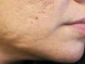 Severe, Deep Acne Scars with Punch Elevation