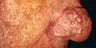 Severe Acne Rosacea