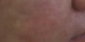 Severe Acne Rosacea Treatment