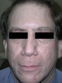 Silicone Microdroplet Therapy for Acne Scars