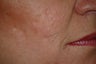 Hetter Facial Resurfacing