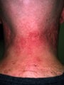 Acne Scarring