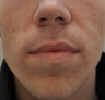 Acne Scarring