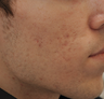Acne Scarring
