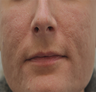 Acne Scarring