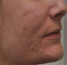 Acne Scarring