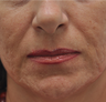 Acne Scarring