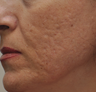 Acne Scarring