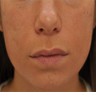 Acne Scarring