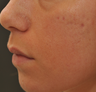 Acne Scarring