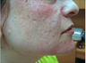 Fractional laser used to treat acne scars