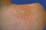 Fraxel Acne Scarring Treatment
