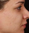Fraxel ReStore for Acne Scarring