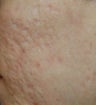 Acne Scar Vitalizer Treatment