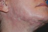 Acne Scar Treatment with Surgical Excisions and Geometric Line Closures.