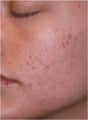 Fraxel - Acne Scarring