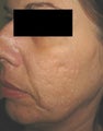 Laser Acne Scar Removal