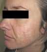 Laser Acne Scar Removal