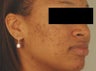 Laser Acne Scar Removal