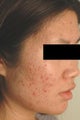 Laser Acne Scar Removal