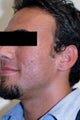 Laser Acne Scar Removal