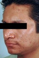 Brown Acne Scars in Santa Ana, CA. Remove Acne Scars with Lasers.