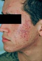 Laser Acne and Acne Scar Treatment