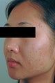 Laser Acne Scar Removal