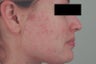 Laser Acne Scar Removal